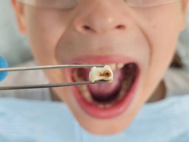 Best Emergency Wisdom Tooth Extraction in Diberville, MS